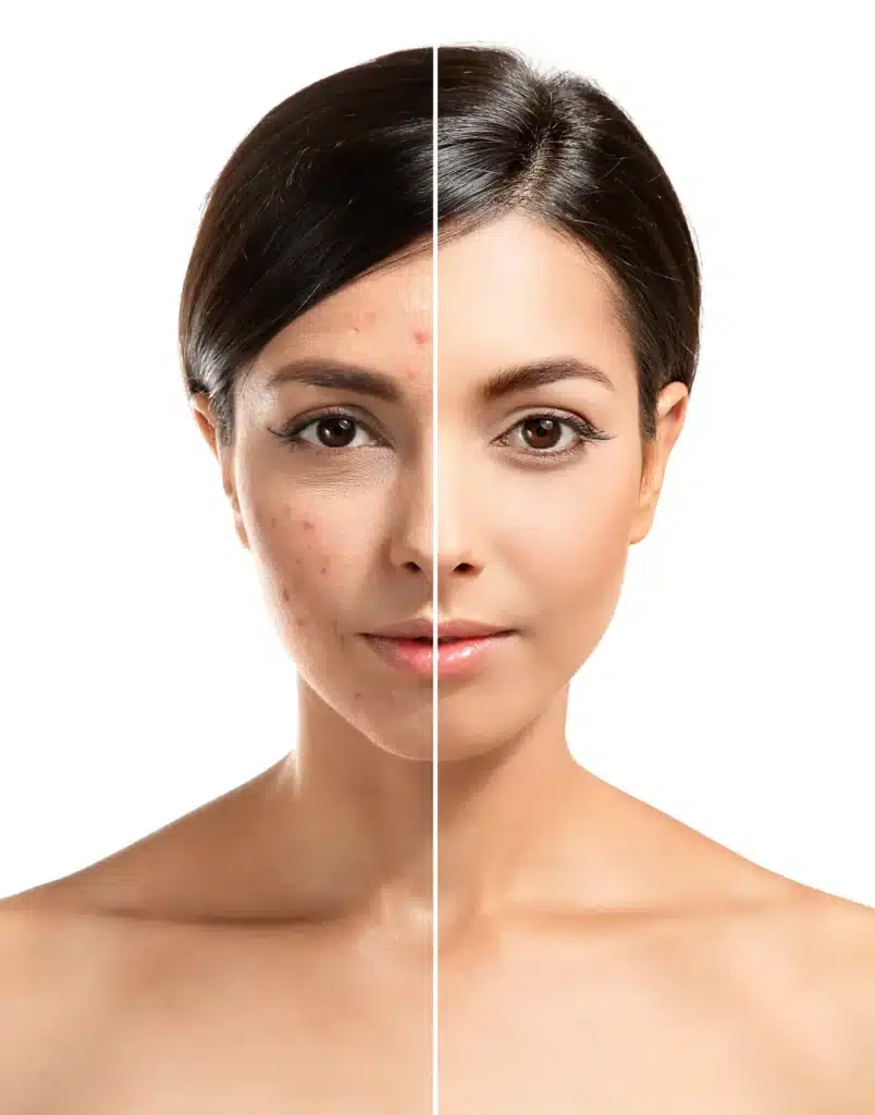 Acne Trifecta Treatment