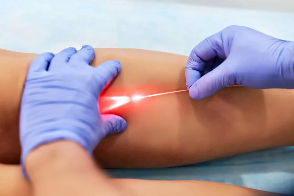 Laser Vein Removal | Samara Medspa