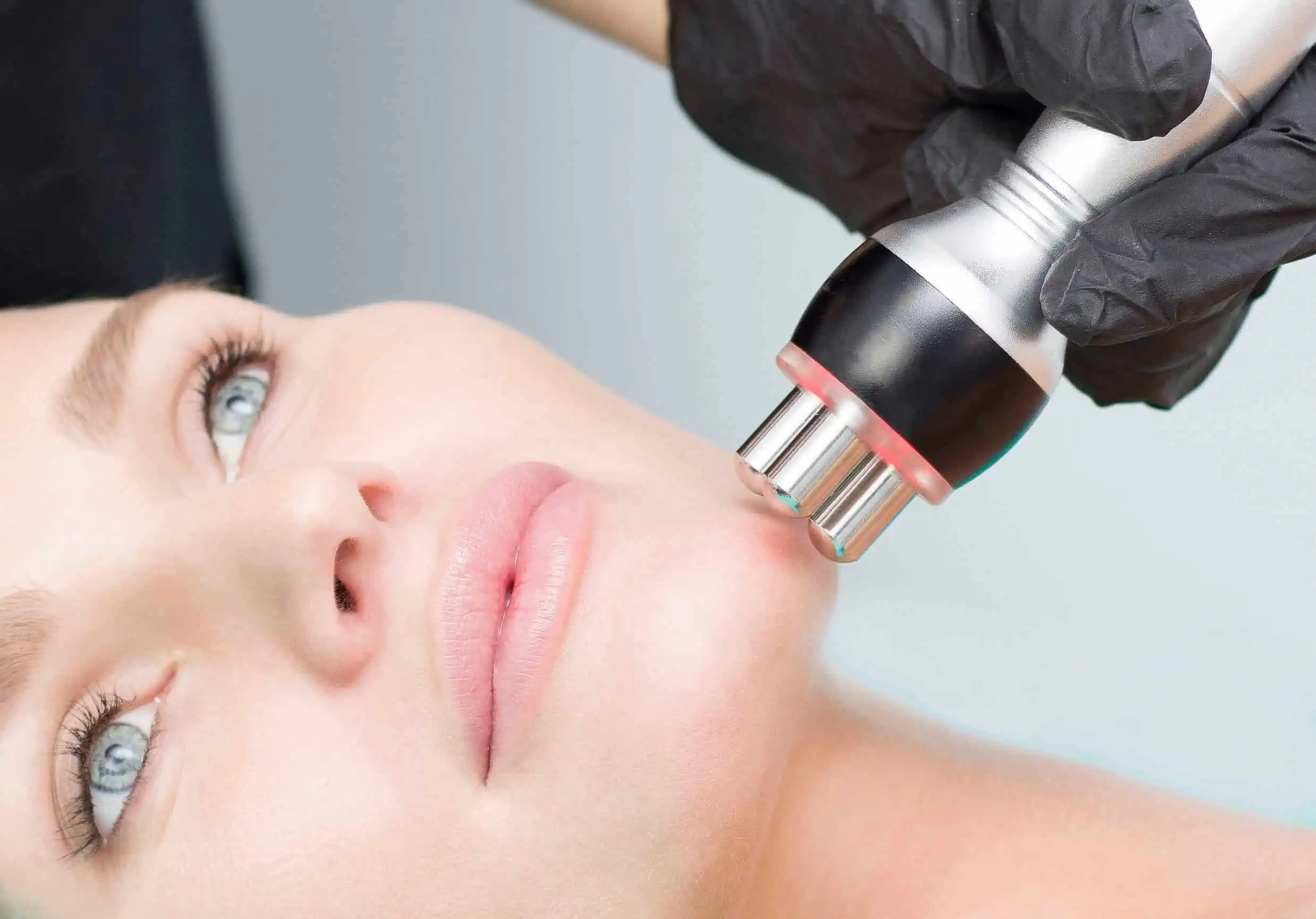 RF Facial Skin Tightening | Samara Medspa