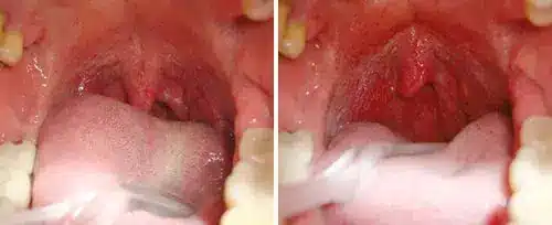 Nightlase Before and After
