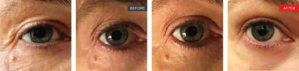 Smooth Eye before and After