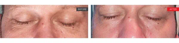 Smooth Eye Before and After