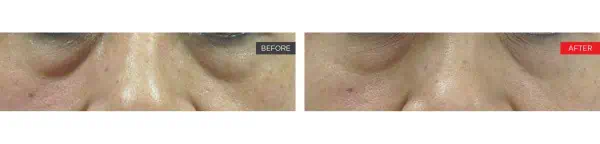 Smooth Eye Before and After
