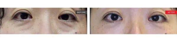 Smooth Eye Before and After